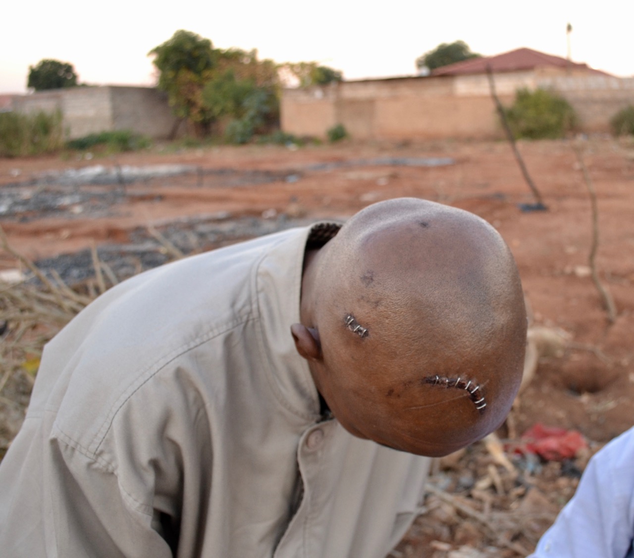 Photo of a man with a shaved head showing wounds